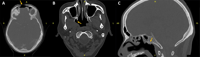 Anterior Skull Base Osteoradionecrosis in the Age of Intensity-Modulated Radiation Therapy: A Case Series.