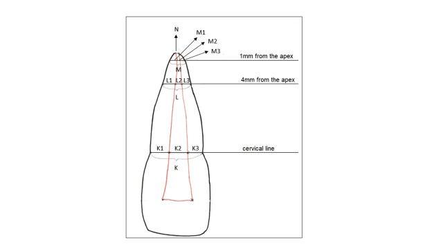 Measurement of the Dentin Wall Thickness of the Maxillary Central Incisor in Relation to the Stage of Root Development: A Pilot Study.