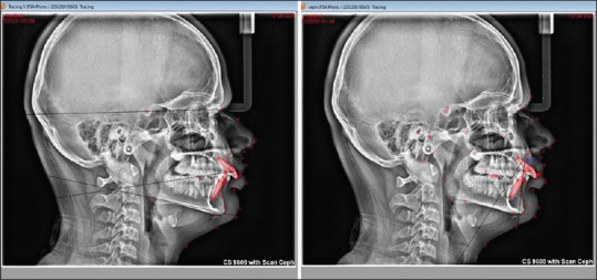 Photographic Frankfort plane subnasale pogonion (FSA) angle for assessment of anteroposterior discrepancies in malocclusion subjects: A prospective study.