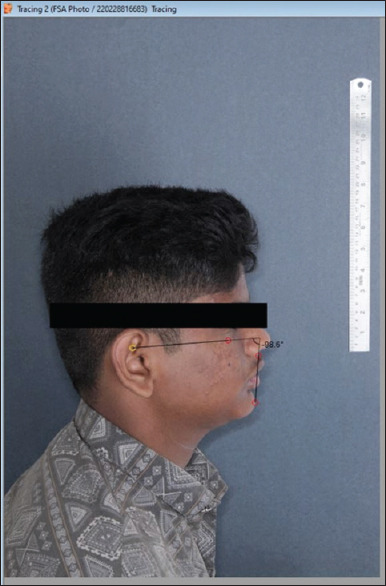 Photographic Frankfort plane subnasale pogonion (FSA) angle for assessment of anteroposterior discrepancies in malocclusion subjects: A prospective study.