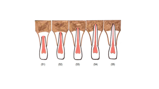 Measurement of the Dentin Wall Thickness of the Maxillary Central Incisor in Relation to the Stage of Root Development: A Pilot Study.