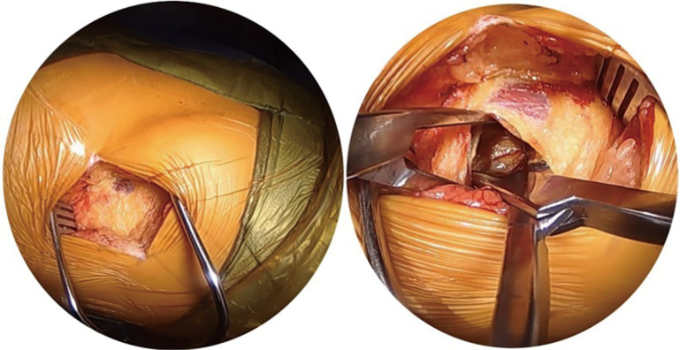 Lumbar lateral interbody fusion: step-by-step surgical technique and clinical experience.