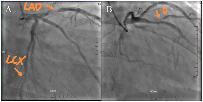 Anthracycline‑induced delayed‑onset cardiac toxicity: A case report and literature review.