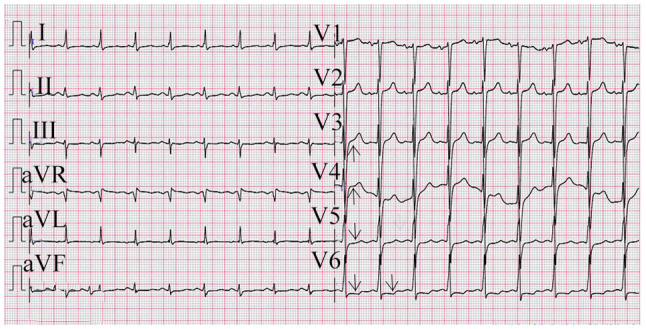 Anthracycline‑induced delayed‑onset cardiac toxicity: A case report and literature review.