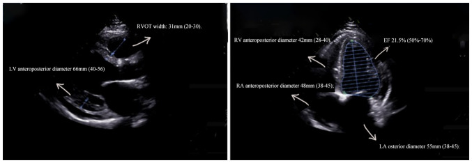 Anthracycline‑induced delayed‑onset cardiac toxicity: A case report and literature review.