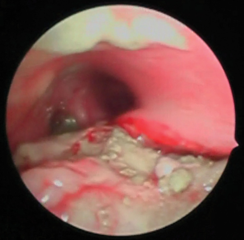 Pediatric Acute Respiratory Distress Syndrome and Tracheal Injury in a Patient Requiring Extracorporeal Membrane Oxygenation Following Cement Aspiration: A Case Report.