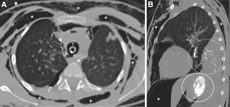 Pediatric Acute Respiratory Distress Syndrome and Tracheal Injury in a Patient Requiring Extracorporeal Membrane Oxygenation Following Cement Aspiration: A Case Report.