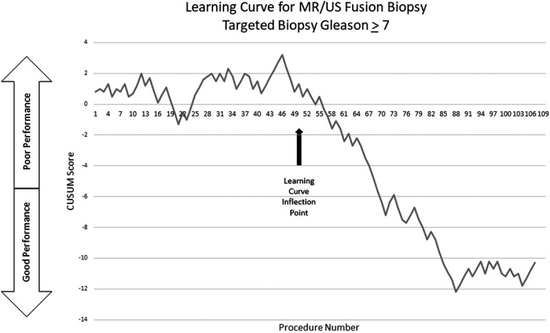 Learning curve for magnetic resonance imaging/ultrasound fusion prostate biopsy in detecting prostate cancer using cumulative sum analysis.