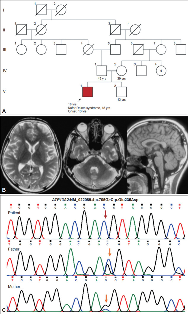 Dystonic Opisthotonus in Kufor-Rakeb Syndrome: Expanding the Phenotypic and Genotypic Spectrum.