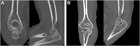 The role of computed tomography in the detection of traumatic arthrotomies of the elbow: a cadaveric study.