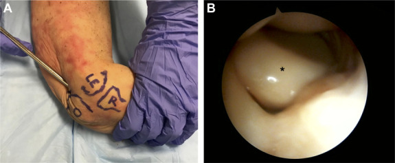 The role of computed tomography in the detection of traumatic arthrotomies of the elbow: a cadaveric study.