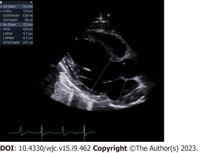 Variant of Wellen's syndrome in type 1 diabetic patient: A case report.