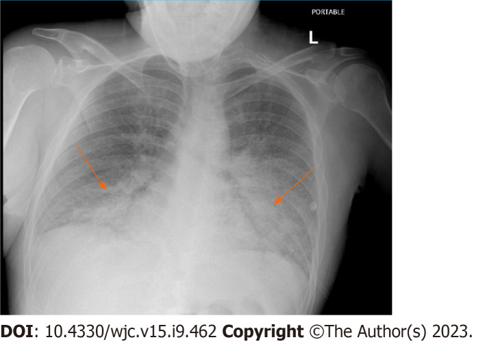 Variant of Wellen's syndrome in type 1 diabetic patient: A case report.