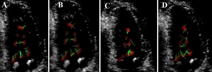 Changes in blood flow vortices inside the left ventricle in COVID-19 patients with intraventricular clot despite a normal coronary and myocardial motion.