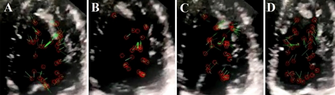 Changes in blood flow vortices inside the left ventricle in COVID-19 patients with intraventricular clot despite a normal coronary and myocardial motion.