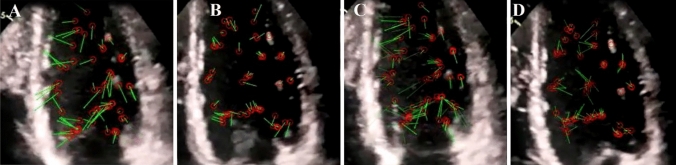 Changes in blood flow vortices inside the left ventricle in COVID-19 patients with intraventricular clot despite a normal coronary and myocardial motion.