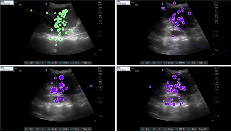 The association of attentional foci and image interpretation accuracy in novices interpreting lung ultrasound images: an eye-tracking study.