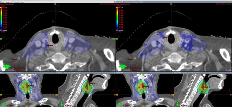 Investigating the feasibility of using Ethos generated treatment plans for head and neck cancer patients