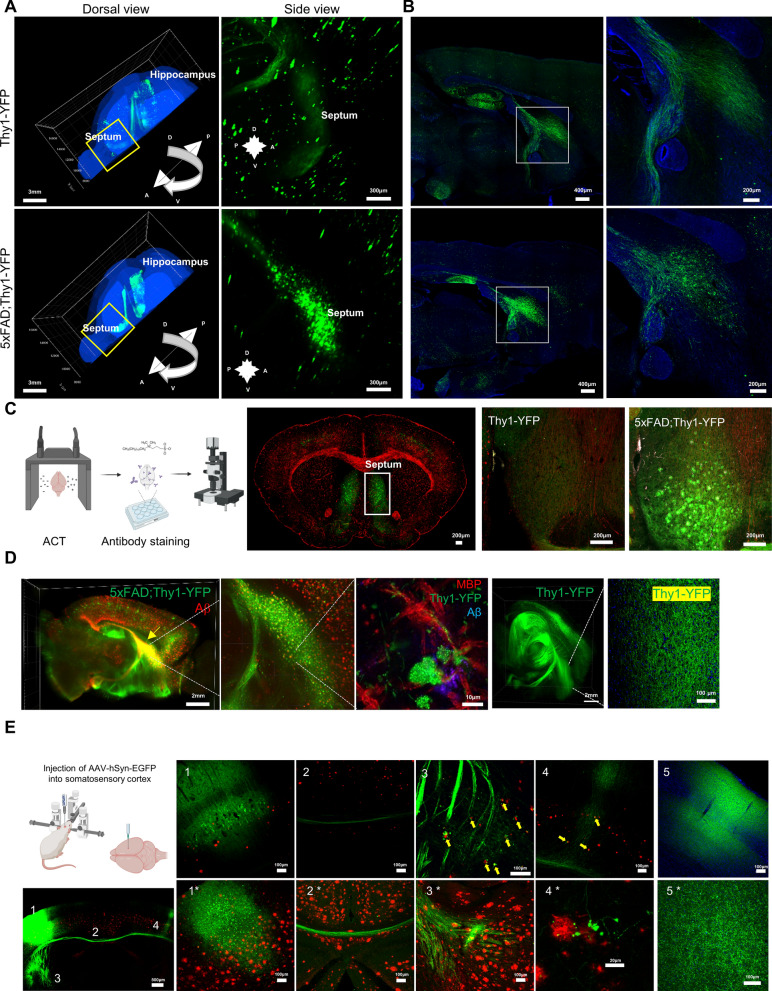 Abnormal accumulation of extracellular vesicles in hippocampal dystrophic axons and regulation by the primary cilia in Alzheimer's disease.