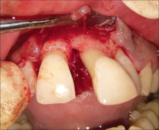 Guided tissue regeneration and orthodontic movement for the treatment of pathological migration in esthetic zone.