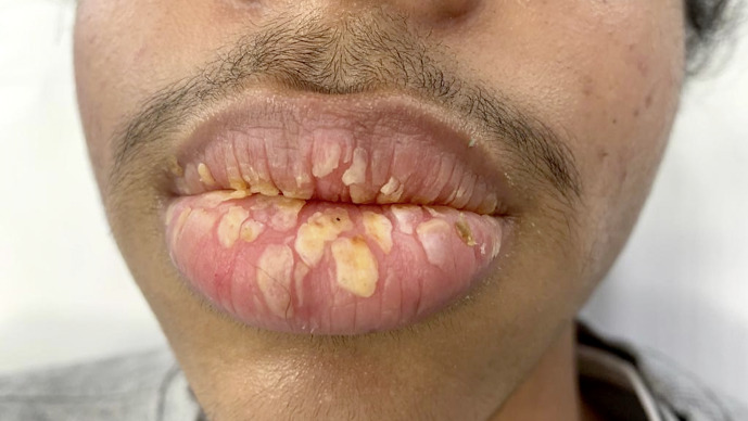 A Case of Lip Psoriasis in a 14-Year-Old Boy Successfully Treated with Adalimumab.