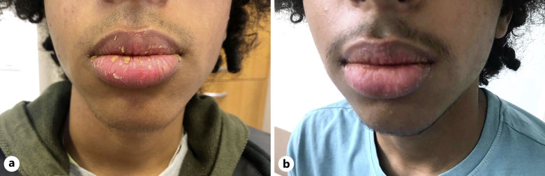 A Case of Lip Psoriasis in a 14-Year-Old Boy Successfully Treated with Adalimumab.