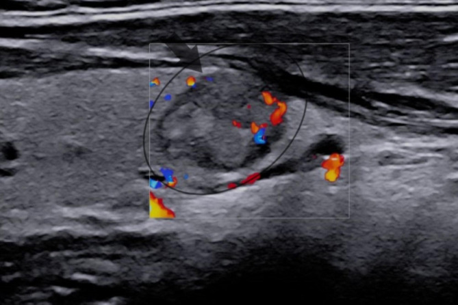 RET/PTC rearrangement in papillary thyroid carcinoma arising in malignant struma ovarii with abdominal wall metastasis and cervical thyroid gland: a case report and review of the literature.