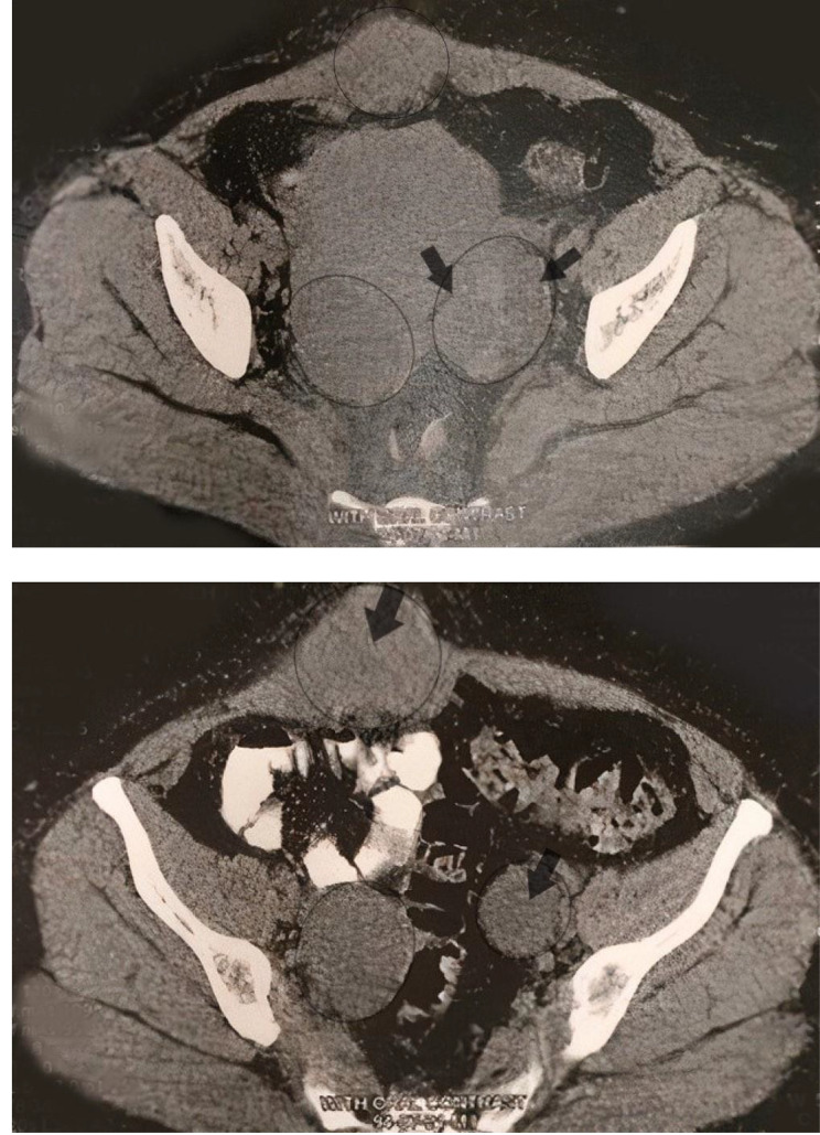 RET/PTC rearrangement in papillary thyroid carcinoma arising in malignant struma ovarii with abdominal wall metastasis and cervical thyroid gland: a case report and review of the literature.