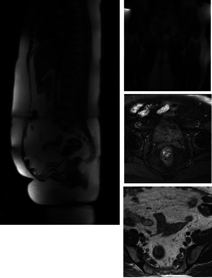 RET/PTC rearrangement in papillary thyroid carcinoma arising in malignant struma ovarii with abdominal wall metastasis and cervical thyroid gland: a case report and review of the literature.