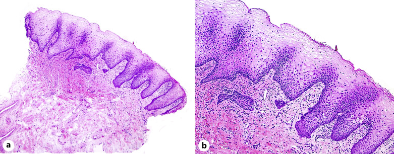 A Case of Lip Psoriasis in a 14-Year-Old Boy Successfully Treated with Adalimumab.