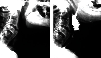 Diffuse Idiopathic Skeletal Hyperostosis Causing Progressive Dysphagia: A Case Report and Review.