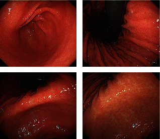 Diffuse Idiopathic Skeletal Hyperostosis Causing Progressive Dysphagia: A Case Report and Review.