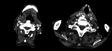 Diffuse Idiopathic Skeletal Hyperostosis Causing Progressive Dysphagia: A Case Report and Review.