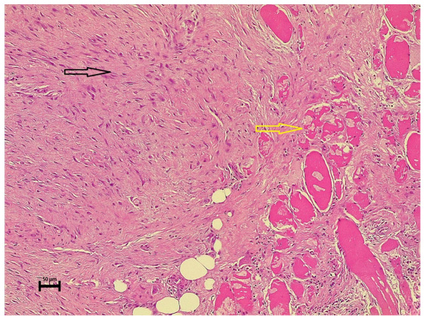 Extra‑abdominal recurrent aggressive fibromatosis: A case series and a literature review.