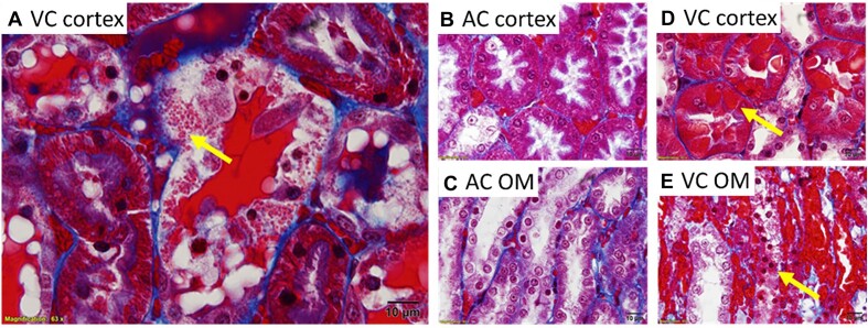 Extravasation of Blood and Blood Toxicity Drives Tubular Injury from RBC Trapping in Ischemic AKI.