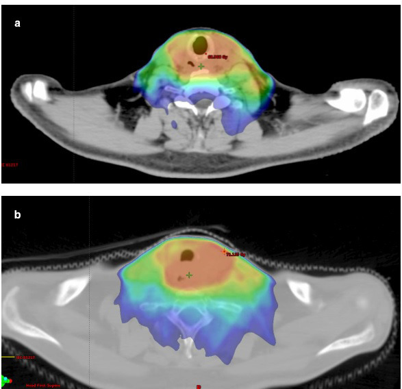 Post-radiotherapy osteomyelitis of the cervical spine in head and neck cancer patients.