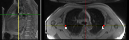 Elastic Registration Algorithm Based on Three-dimensional Pulmonary MRI in Quantitative Assessment of Severity of Idiopathic Pulmonary Fibrosis.