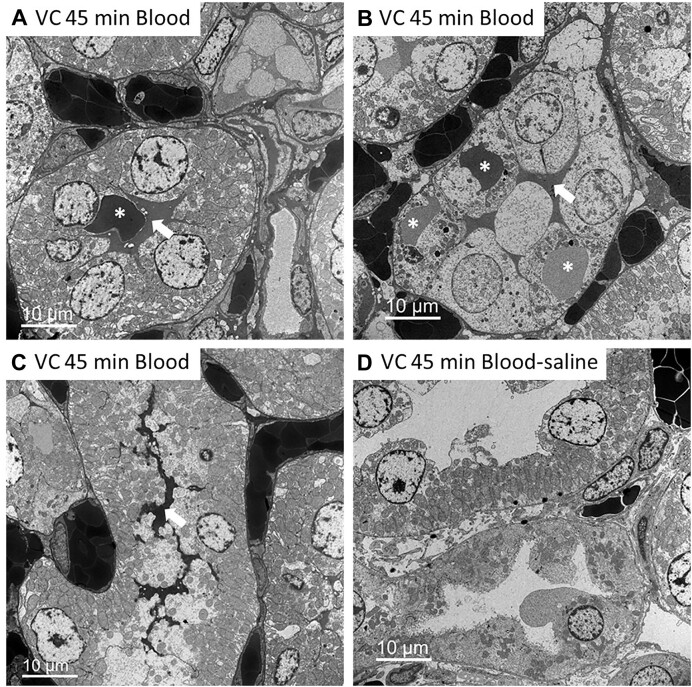 Extravasation of Blood and Blood Toxicity Drives Tubular Injury from RBC Trapping in Ischemic AKI.