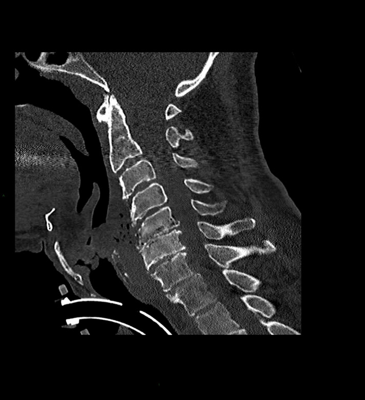 Post-radiotherapy osteomyelitis of the cervical spine in head and neck cancer patients.