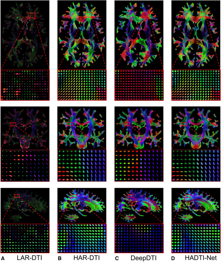 High angular diffusion tensor imaging estimation from minimal evenly distributed diffusion gradient directions.