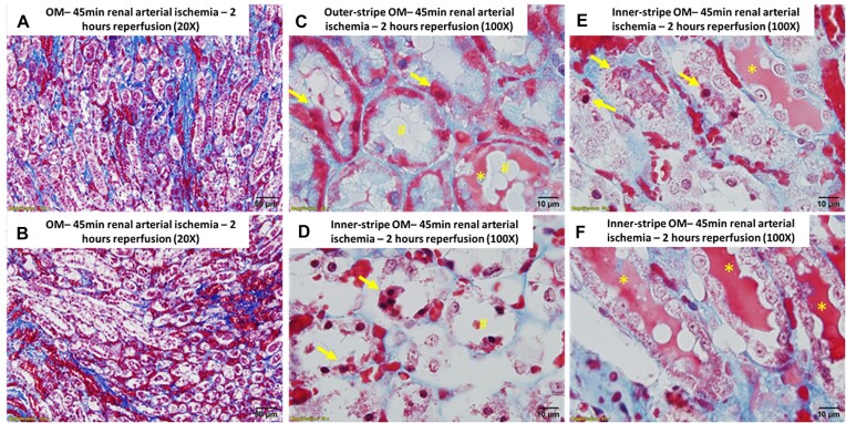 Extravasation of Blood and Blood Toxicity Drives Tubular Injury from RBC Trapping in Ischemic AKI.