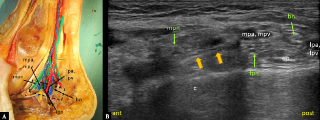 Sonographic assessment of the tarsal tunnel compared to cadaveric findings: a pictorial study.