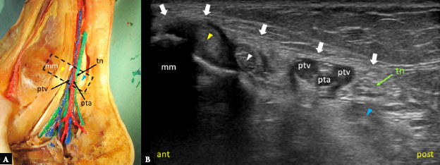 Sonographic assessment of the tarsal tunnel compared to cadaveric findings: a pictorial study.