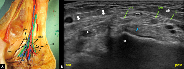 Sonographic assessment of the tarsal tunnel compared to cadaveric findings: a pictorial study.