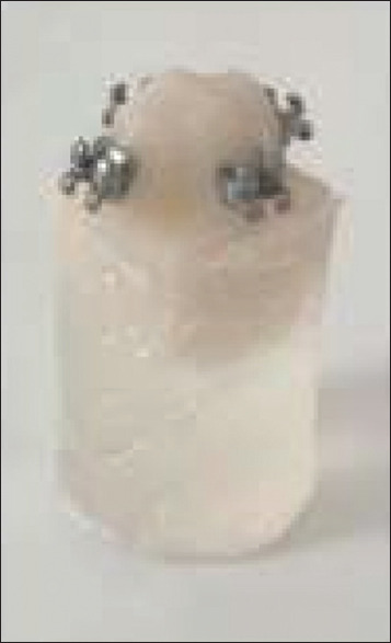 The effect of ceramic surface conditioning on bond strength of metallic brackets: An <i>in vitro</i> study.
