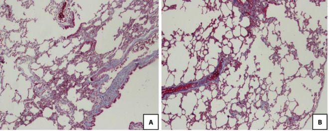 Protective efficacy of pirfenidone in rats with pulmonary fibrosis induced by bleomycin.