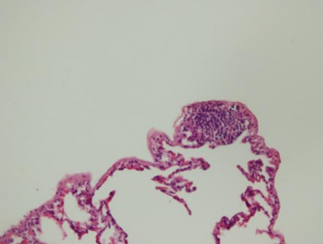 Protective efficacy of pirfenidone in rats with pulmonary fibrosis induced by bleomycin.