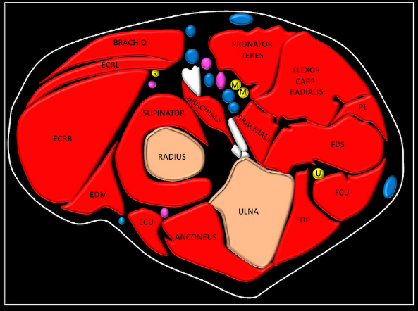 Ultrasound-guided median nerve hydrodissection of pronator teres syndrome: a case report and a literature review.