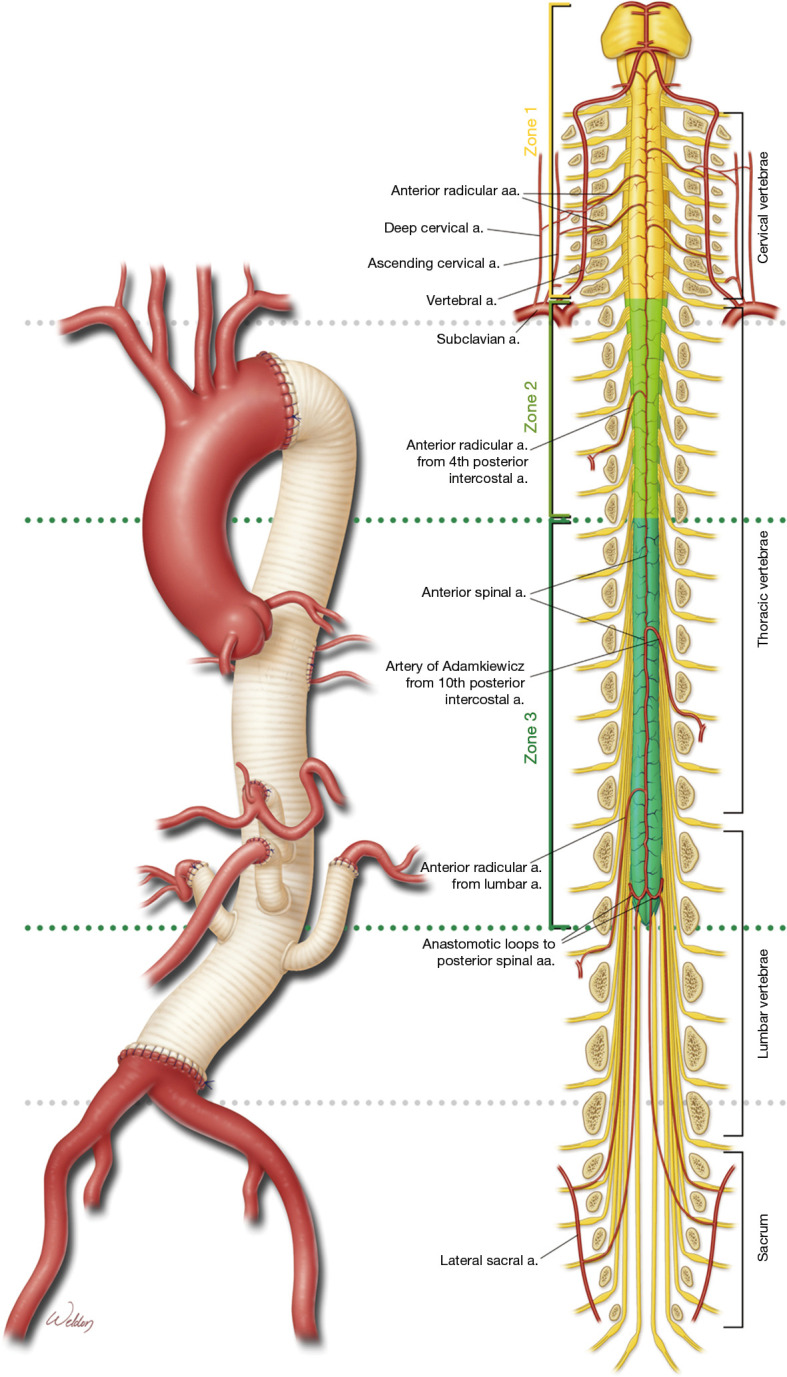 Current approaches to spinal cord protection during open thoracoabdominal aortic aneurysm repair.