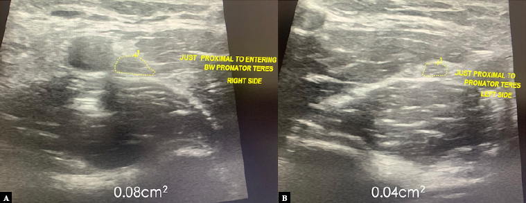 Ultrasound-guided median nerve hydrodissection of pronator teres syndrome: a case report and a literature review.